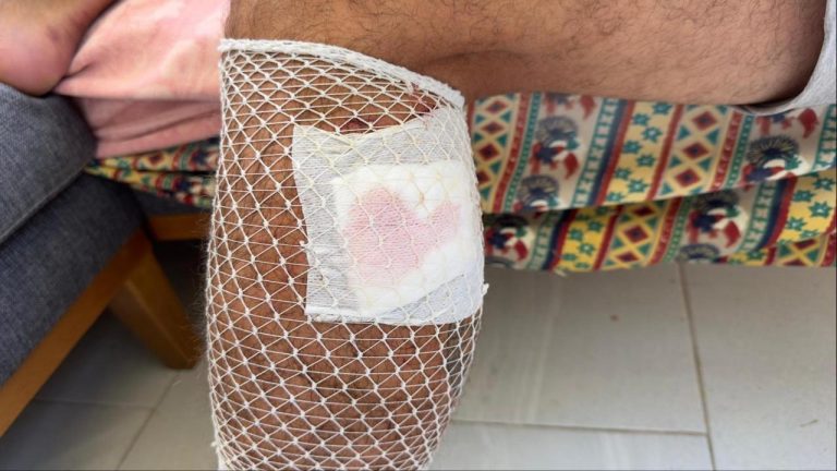 Yürüyüş yaparken başıboş sokak köpeklerinin saldırısına uğradı