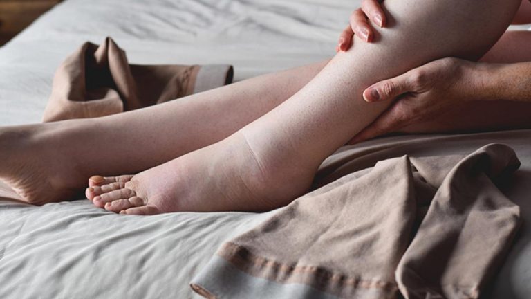 Bir ayağınız diğerinden büyükse dikkat: Tek taraflı şişlik lenfödem habercisi olabilir